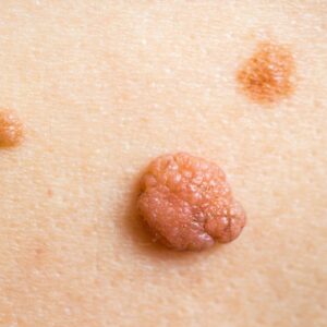 Skin Tags: Causes, Risks & Removal Options